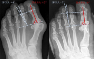 CPT Code for an Akin Osteotomy