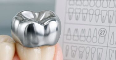 Dental Code for a Metal Crown