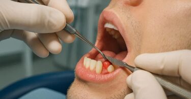 Removal of Operculum Dental Code