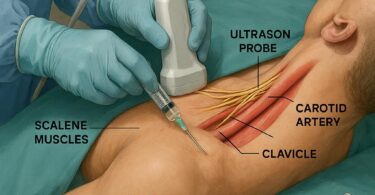 CPT Code for Interscalene Block