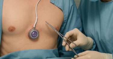 CPT Code for Port-a-Cath Placement