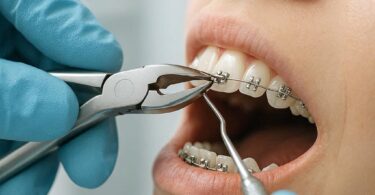 Dental Code for Bracket Removal