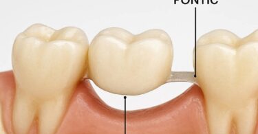 Dental Code for Ribbond Bridge