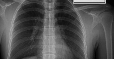 ICD 10 Code for X-Ray of Thoracic Spine