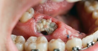 Does Tooth Extraction Site Turn White?