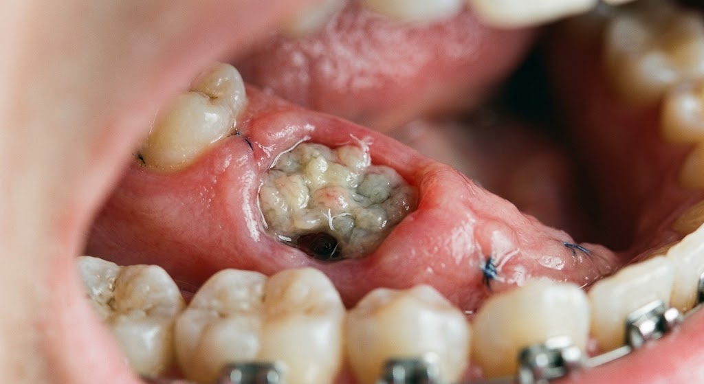 Does Tooth Extraction Site Turn White?