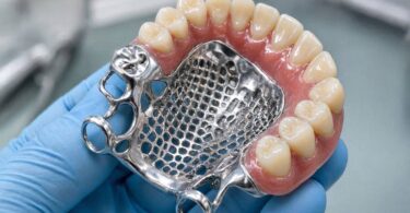 What Do Metal Partial Dentures Look Like?