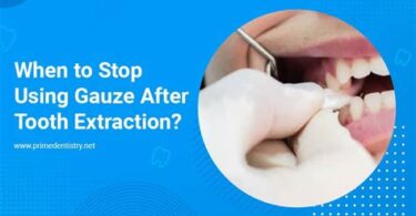 When Can You Stop Using Gauze After Having Your Wisdom Teeth Extracted?