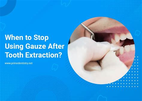 When Can You Stop Using Gauze After Having Your Wisdom Teeth Extracted?