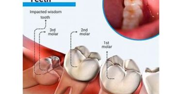 When The Wisdom Teeth Of Dancers Are Extracted