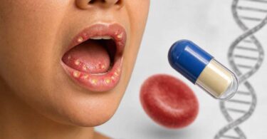 what vitamin deficiency causes mouth ulcers